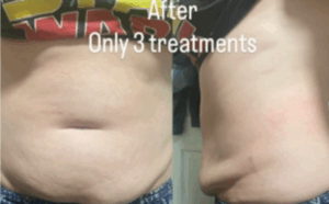 After Body Contouring